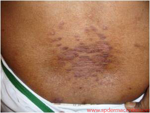 Psoriasis-OnTreatment